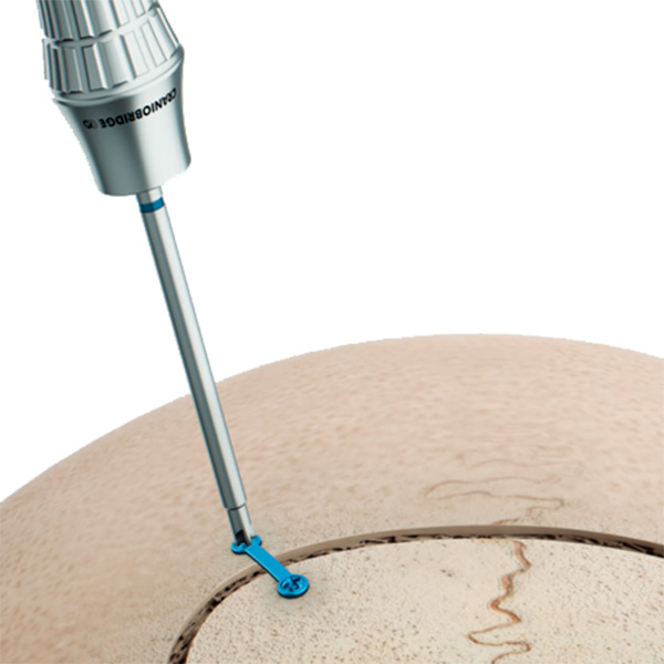 Subiton cráneo - GS BIO - Implantes Quirúrgicos SA